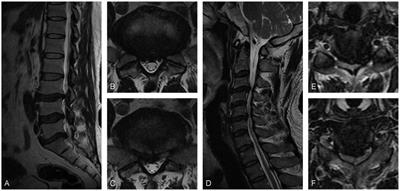 Sciatica-like pain caused by cervical spondylotic myelopathy: four case reports and systematic review